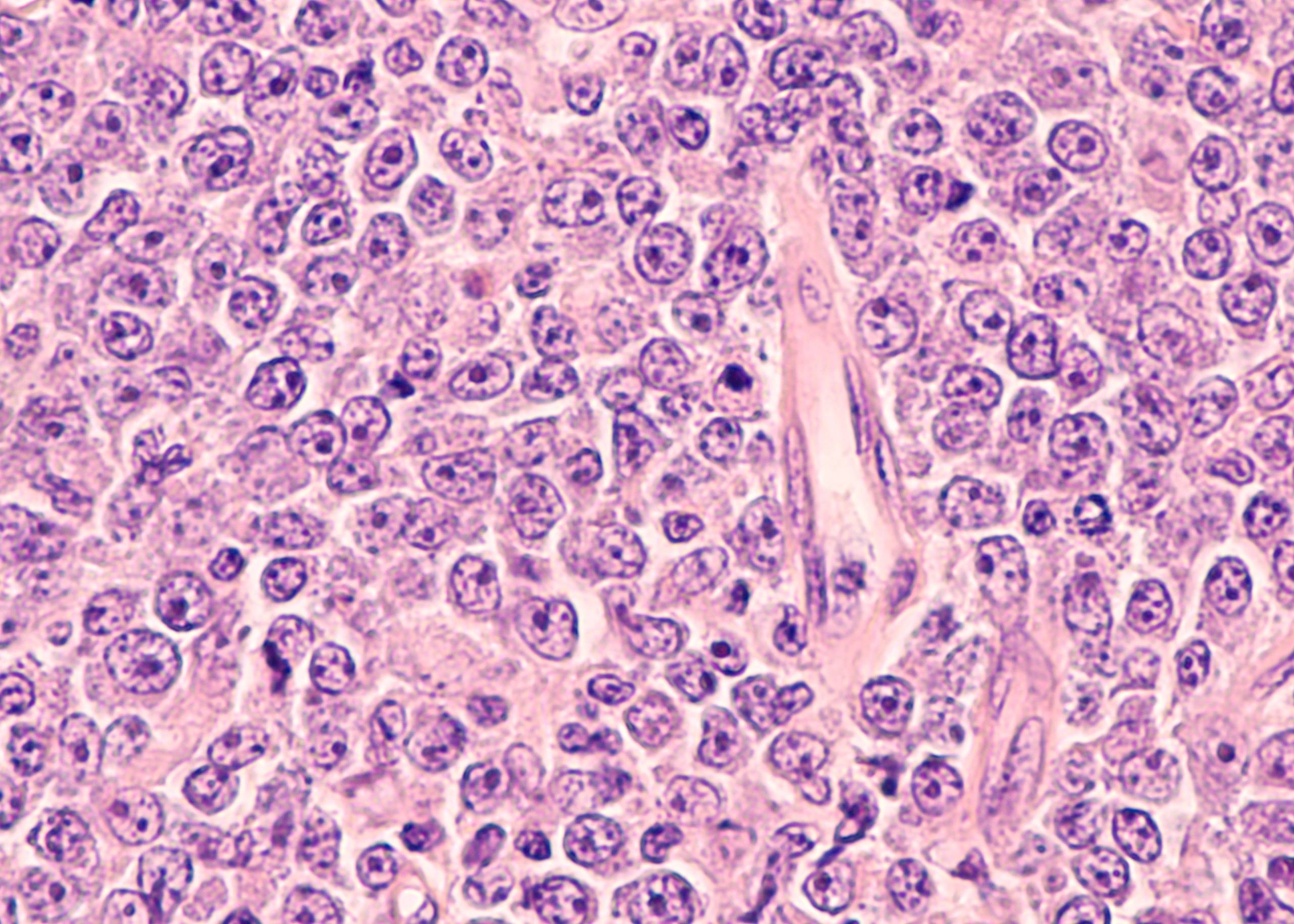 Lymphoma – Symptoms, Causes & Treatment